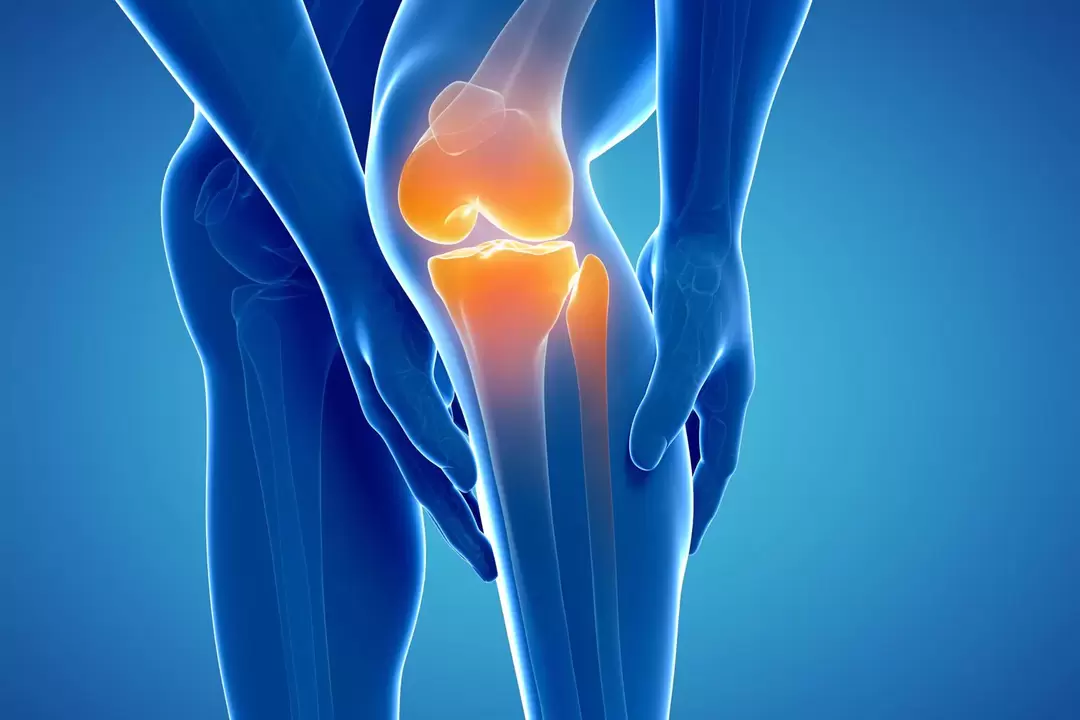 Osteoarthritis of the knee joint (gonarthrosis, deforming arthrosis)