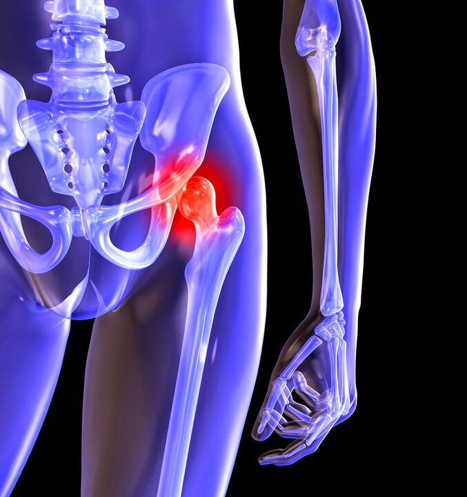 Distorting osteoarthritis of the hip joint