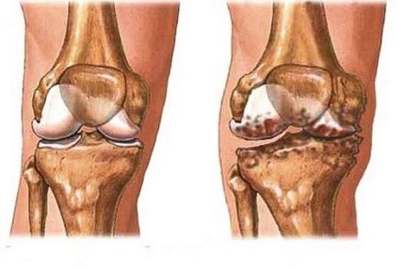 Healthy and bad joint