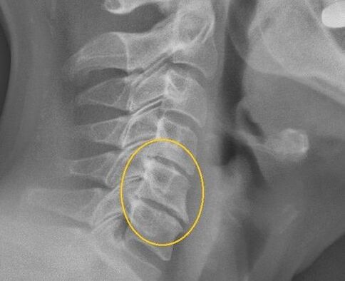 Osteochondrosis of the cervical column on an X radius