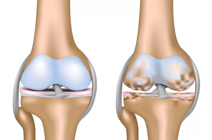 Distorting osteoarthritis of the knee joint