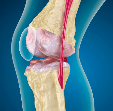 Knee joint arthrososis